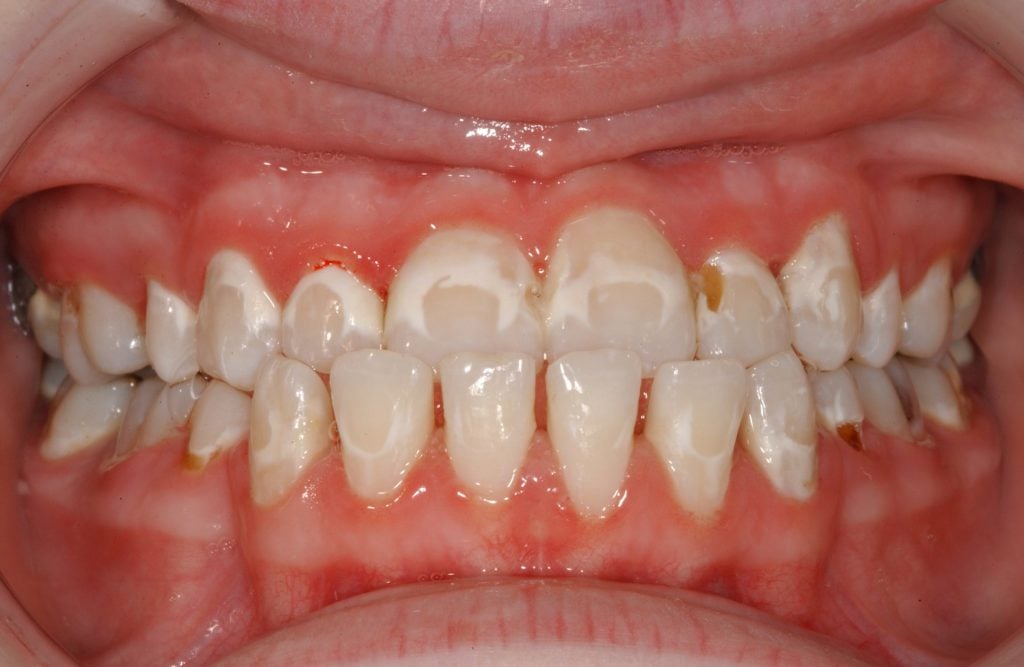 How To Brush Teeth With Braces Properly Braces Archives Evolution how-to-brush-teeth-with-braces-properly-braces-archives-evolution