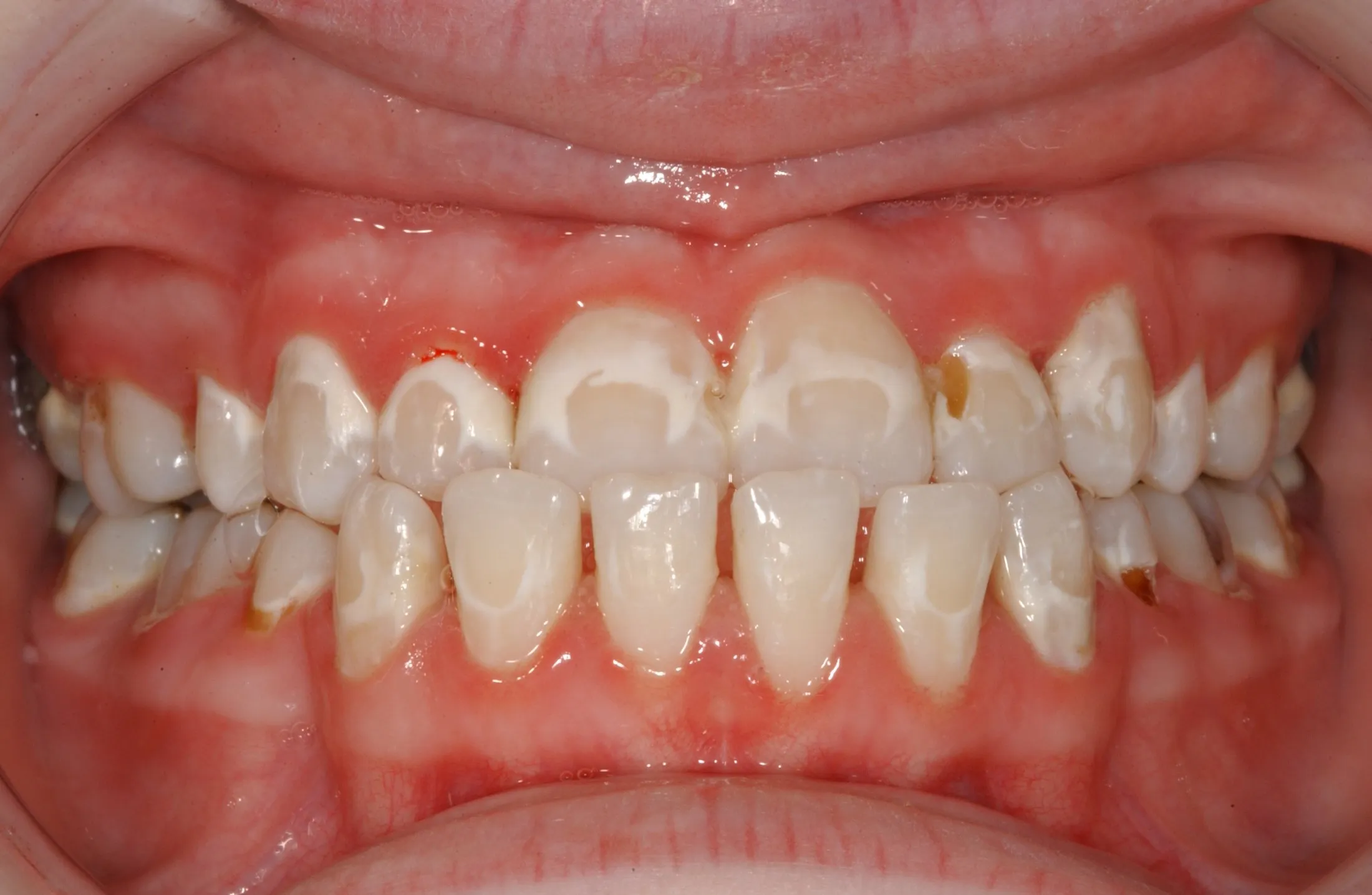 Orthodontic Brushing and Flossing Mt. Pleasant IA