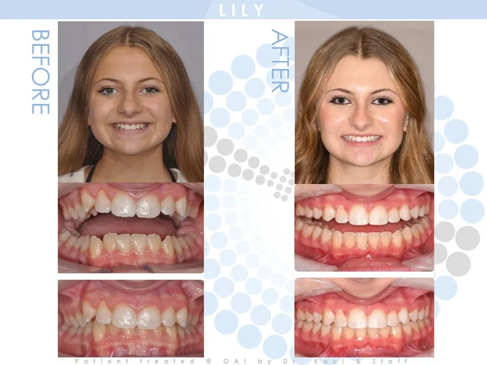 OAI Before and After Smile Gallery Mt. Pleasant IA, ORTHODONTIC ASSOCIATES  of IOWA