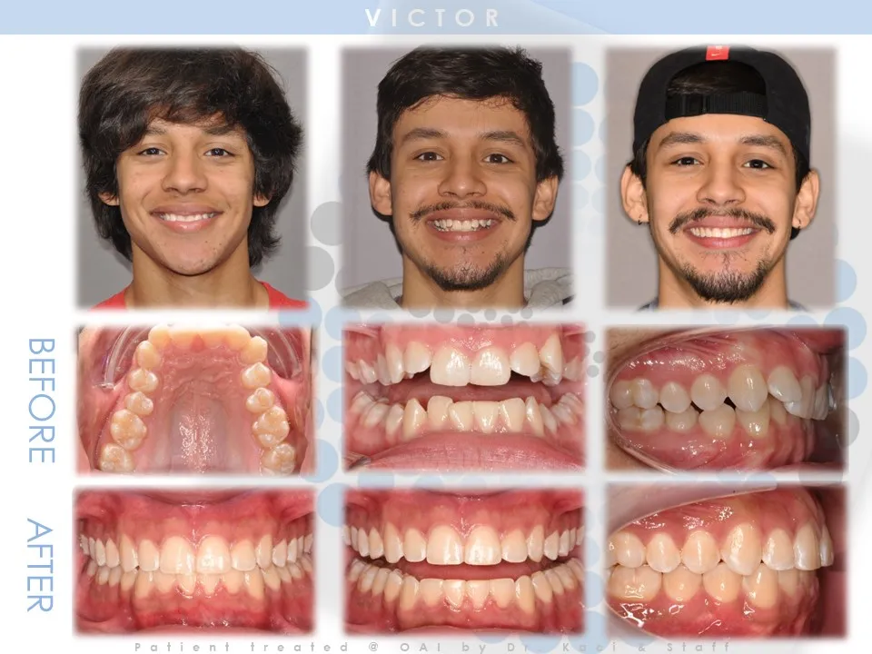 OAI Before and After Smile Gallery Mt. Pleasant IA, ORTHODONTIC ASSOCIATES  of IOWA